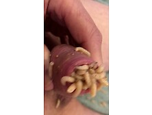 Maggots In Foreskin