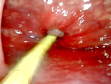 EXTREME ANAL SELF PERSPECTIVE.  CAM INSIDE HER ASS-HOLE AS I POUND HER WITH MY LARGE ROD AND JIZZ DEEP INSIDE