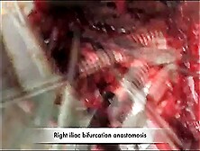 Open Abdominal Aortic Aneurysm Repair 5