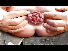 Prolapse Anal Gape - Extrem Ass Anus After Rectum