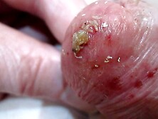 Baby Maggots Burrow Into Cock To Grow