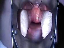 Monster Speculum Anal