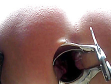 Anal Extreme Speculum In The Asshole