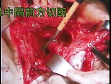 Anterior Skull Base Tumor Resection