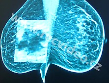 Various MILFs' having mammograms