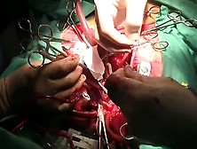 Artial Septal Defect Closure Woman Cm. Flv