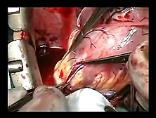 Coronary Artery Bypass With Mitral Valve Replacement Cm. Flv