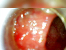 USB endoscope 80 cm deep anal insertion