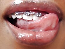Black girl teeth brace fetish!
