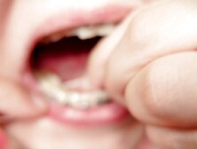 My 2nd day in braces: cleaning by dental floss