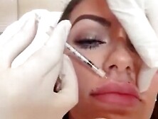 Lip Filler Procedure for Bimbo