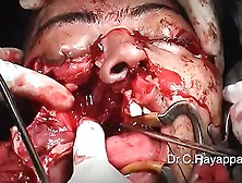 Midfacial Split Surgery Young Woman