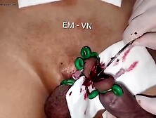 Em-Vn Penectomy