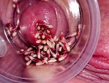 Maggots In Small Dick Close Up 2