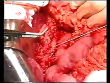 Gastrectomy Russian Man Gastric Cancer Cm. Avi