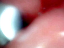 Endoscope camera captures moment of male ejaculation